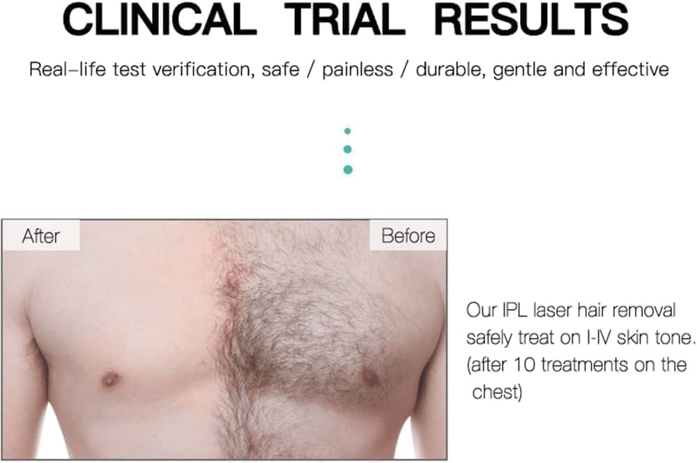 IPL Laser Hair Removal | Laser Permanent Hair Removal | Painless Permanent Hair Removal